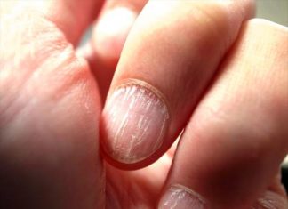 നഖത്തിലെ ഈ വര ചില്ലറയല്ല; ഗുരുതരരോഗങ്ങൾ പുറകേതന്നെ