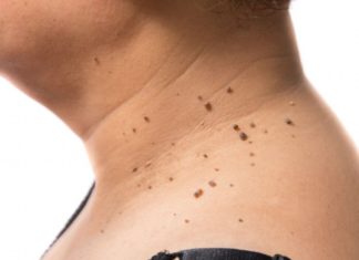 പാലുണ്ണി മാറാൻ ഇതാ ചില പരിഹാരങ്ങൾ