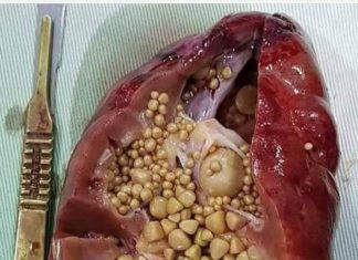 കിഡ്നിയുടെ ആരോഗ്യം സംരക്ഷിക്കാൻ ചെയ്യേണ്ട ചില കാര്യങ്ങൾ