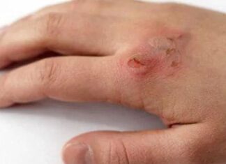 പൊള്ളലേറ്റ ചർമത്തിലെ പാടുകൾ അകറ്റാം