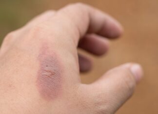 പൊള്ളലേറ്റാല് ഇതൊന്നും ചെയ്യരുത്; കാരണം