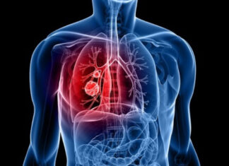 ശ്വാസകോശ അര്ബുദം;