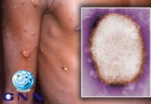 മങ്കിപോക്സ് കോവിഡിനെകാൾ മാരകമോ..?