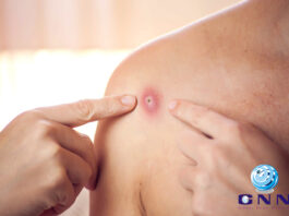 അയർലണ്ടിൽ വീണ്ടും മങ്കിപോക്സ് സ്ഥിരീകരിച്ചു