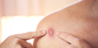 മങ്കിപോക്സ് രോഗബാധിതര്ക്ക് നിര്ബന്ധിത ക്വാറന്റൈന് ഏര്പ്പെടുത്തി