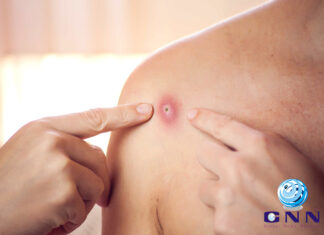 മങ്കിപോക്സ് രോഗബാധിതര്ക്ക് നിര്ബന്ധിത ക്വാറന്റൈന് ഏര്പ്പെടുത്തി