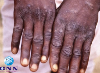 സൗദി അറേബ്യയിൽ കുരങ്ങുപനി കേസുകളൊന്നും കണ്ടെത്തിയിട്ടില്ലെന്ന് ആരോഗ്യ മന്ത്രാലയം; ചികിത്സിക്കാനും രോഗവ്യാപനം തടയാനുമുള്ള സജ്ജീകരണങ്ങൾ തയ്യാറായി