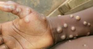 സംസ്ഥാനത്ത് ഒരാള്ക്ക് കൂടി മങ്കിപോക്സ് സ്ഥിരീകരിച്ചു