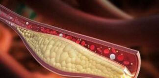 ഉയർന്ന കൊളസ്ട്രോൾ: ഈ ലക്ഷണങ്ങൾ അവഗണിക്കരുത്..