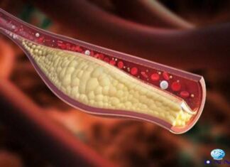 ഉയർന്ന കൊളസ്ട്രോൾ: ഈ ലക്ഷണങ്ങൾ അവഗണിക്കരുത്..