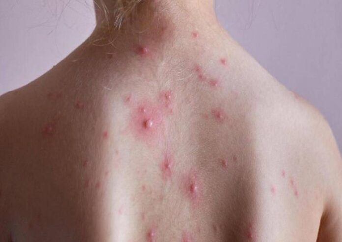 monkeypox-alert-in-kerala (1)