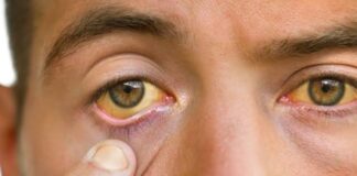 മഞ്ഞപ്പിത്തം ഉള്ള ആളുടെ കണ്ണിനു മഞ്ഞ നിറം ഉണ്ടാവാൻ കാരണം എന്ത്?