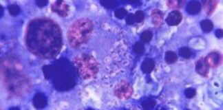 രോഗികളിൽ ചികിത്സ; പ്രതിരോധശേഷിയുള്ള റിംഗ് വോമിന്റെ ആദ്യകേസുകൾ കണ്ടെത്തി -പി പി ചെറിയാൻ