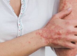 സോറിയാസിസ്