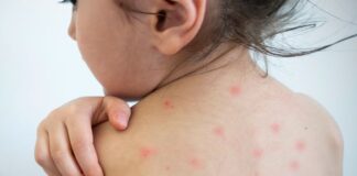 യൂറോപ്പിൽ മീസിൽസ് കേസുകൾ 42,200 ആയി ഉയർന്നു, 45 മടങ്ങ് വർധന