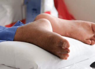 ഗില്ലെയ്ൻ ബാരെ സിൻഡ്രോം; മരണസംഖ്യ രണ്ടായി