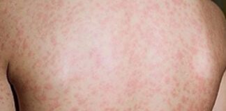 അലബാമയിൽ കടുത്ത ജാഗ്രത; ‘ഏറ്റവും പകർച്ചവ്യാധിയുള്ള’ അഞ്ചാംപനി രോഗം പടരുന്നു