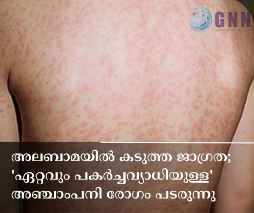 അലബാമയിൽ കടുത്ത ജാഗ്രത; ‘ഏറ്റവും പകർച്ചവ്യാധിയുള്ള’ അഞ്ചാംപനി രോഗം പടരുന്നു